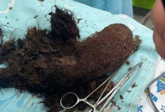 Из желудка 12-летней девочки в Сургуте достали огромный комок волос