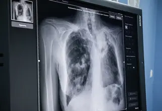 В Россию проник устойчивый к лекарствам штамм-мутант туберкулеза