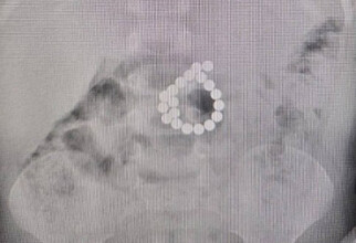 В ХМАО ребенок проглотил 19 магнитиков и чуть не умер